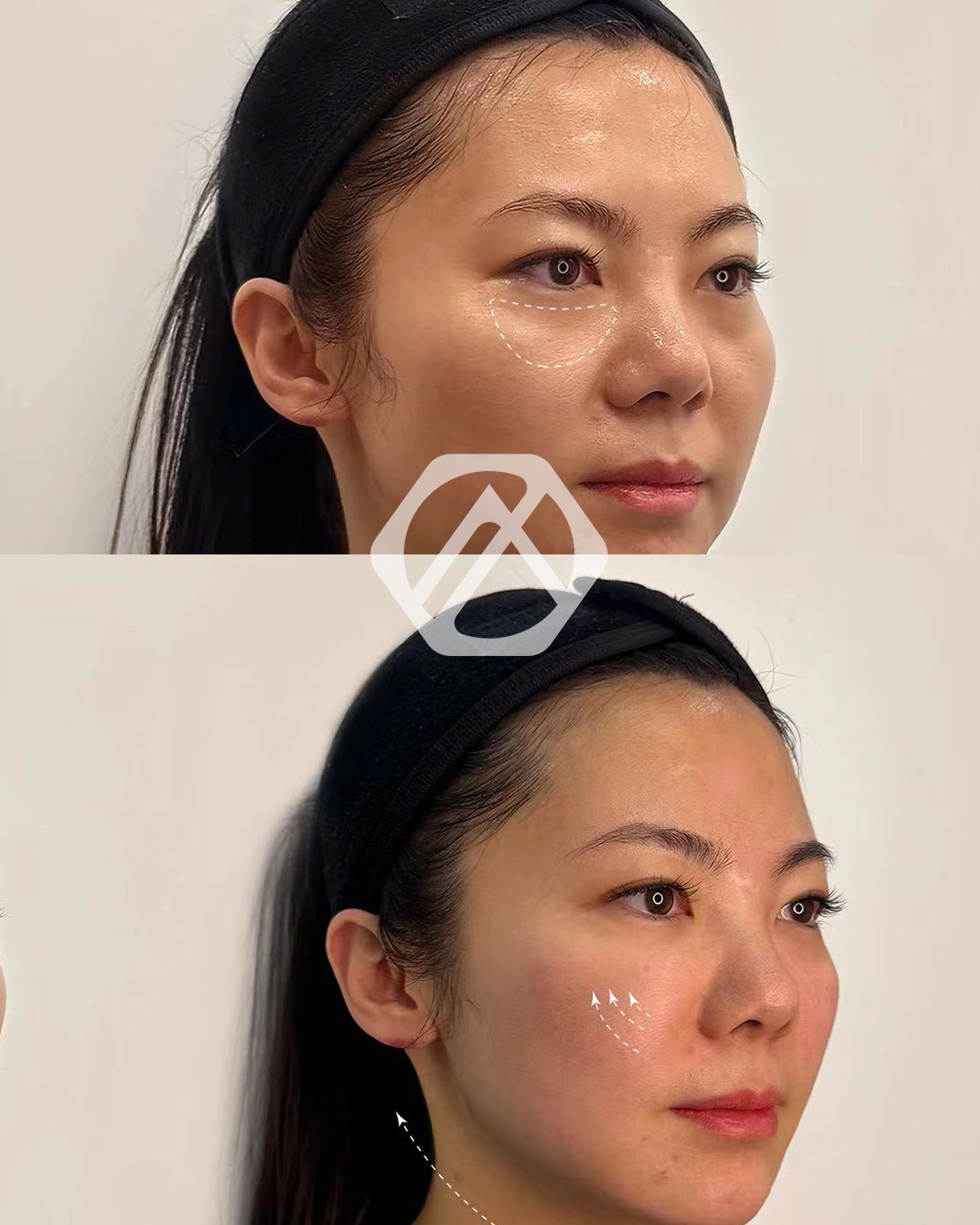 Botox a