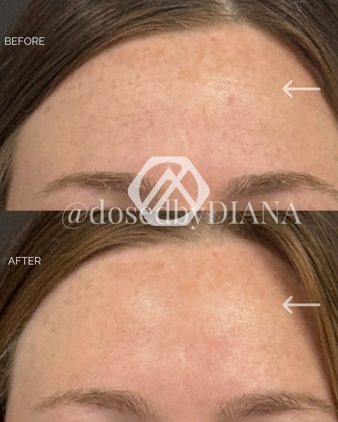 Botox b