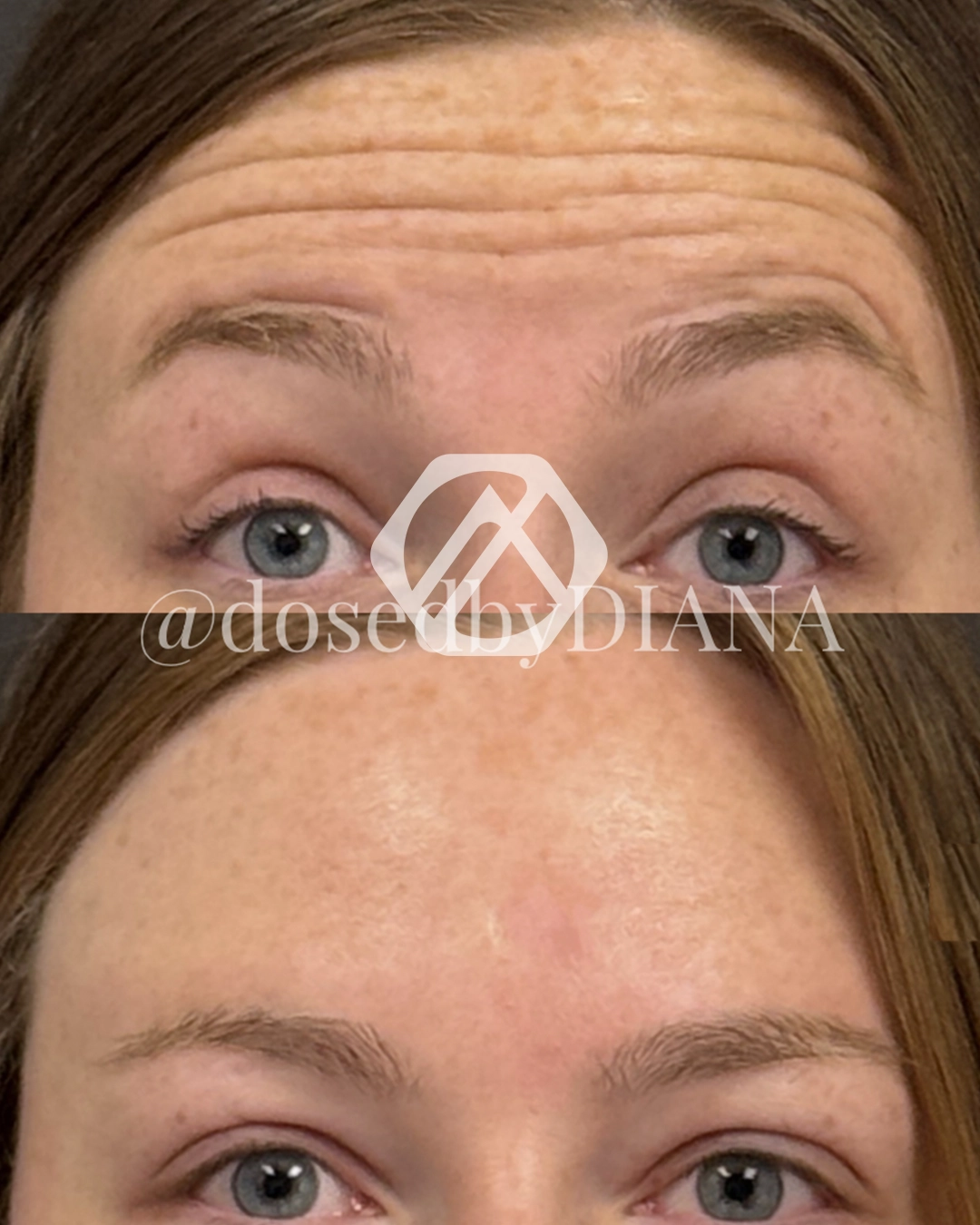 Botox c