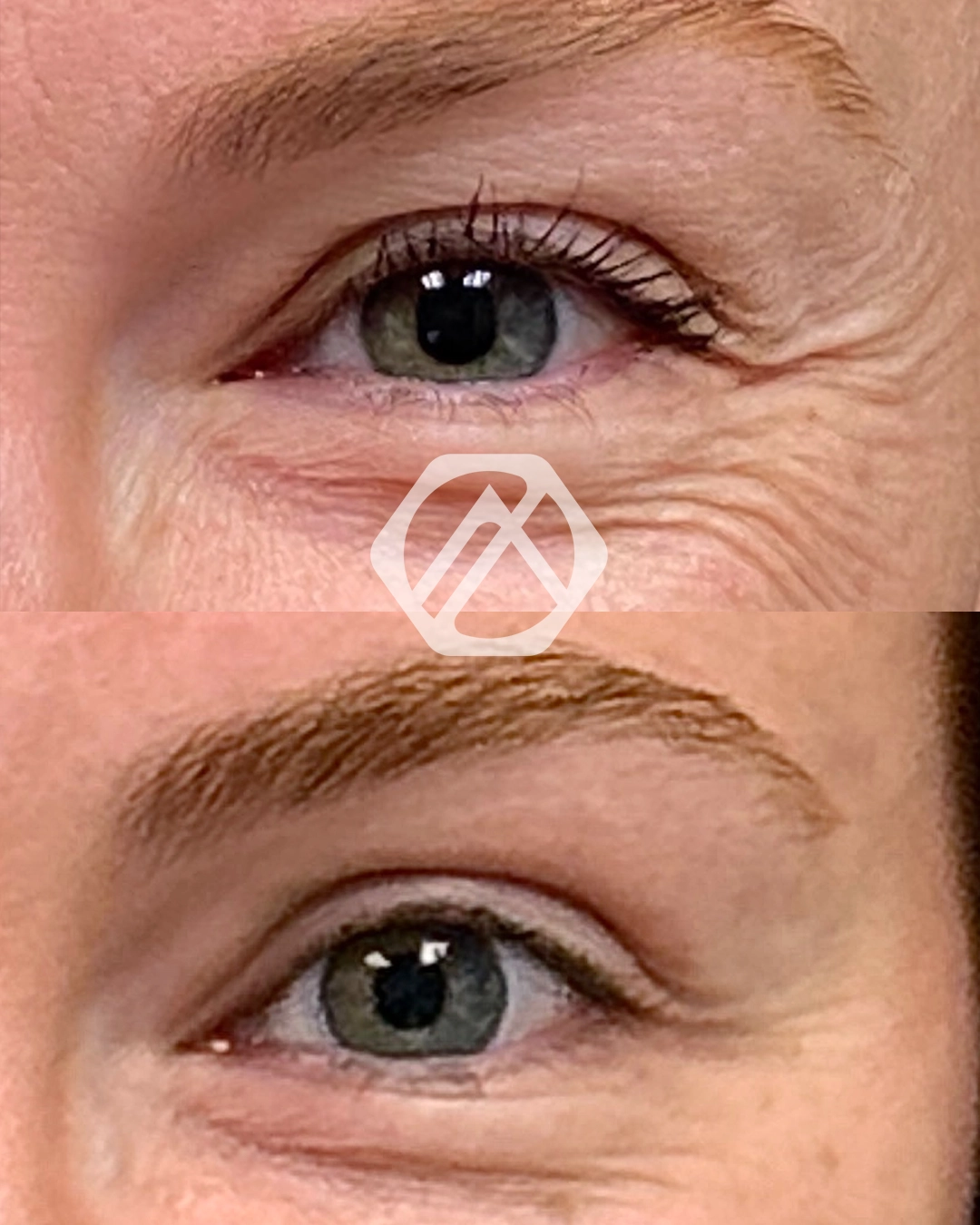 Botox e