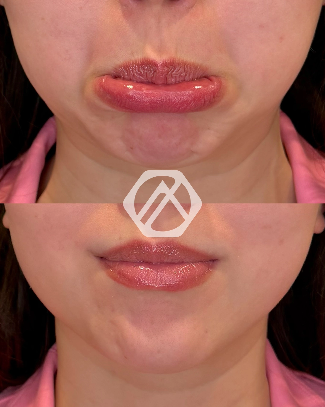 Botox f