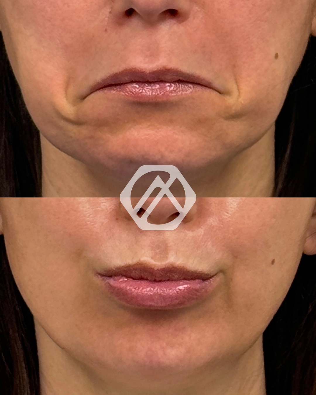 Botox g
