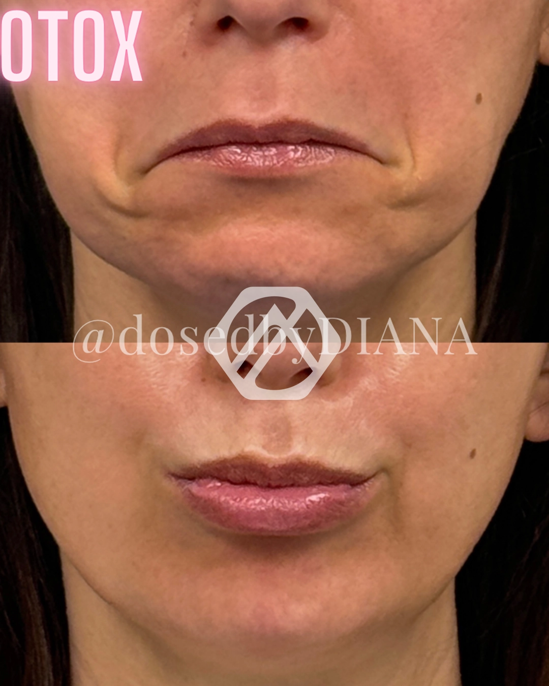 Botox h